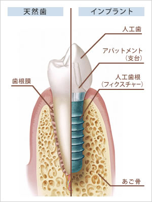 インプラントとは？